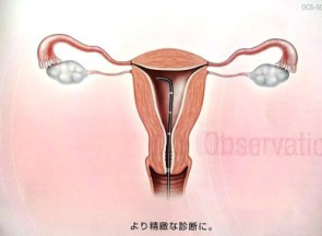 子宮鏡検査について