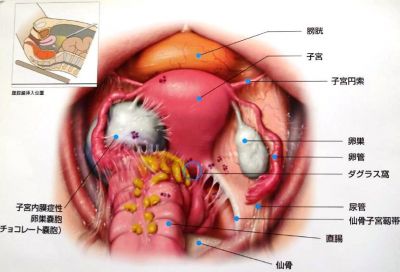 痛い 子宮